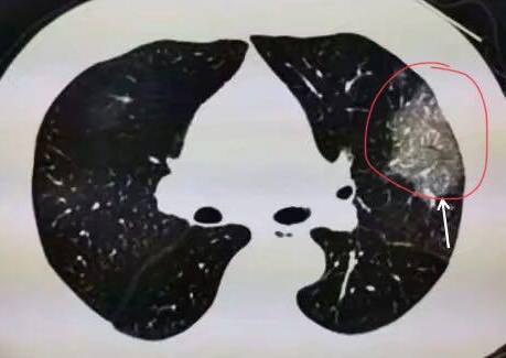 新加坡41歲中國客工新冠病逝後，帶來的警示!