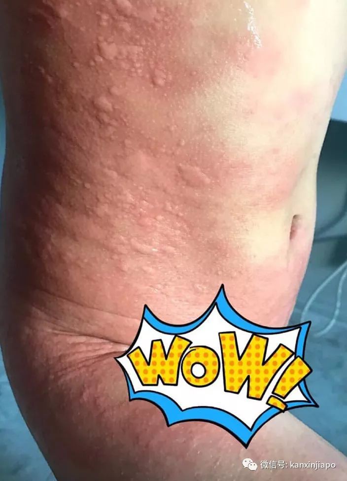 罕见！新加坡5岁女孩游泳后全身红肿，刺痛无比......