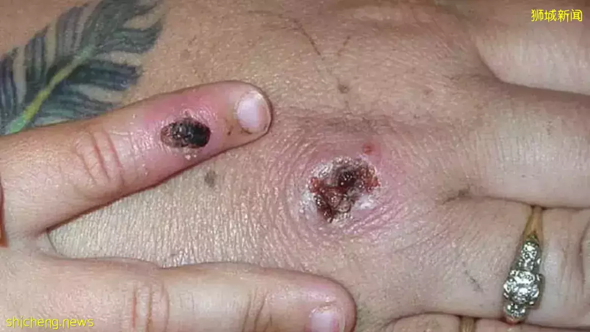 专家：猴痘病毒传染力不是很强 有疫苗应付无需过于担心