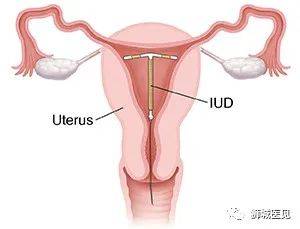 救命!家里的熊孩子不能再多了!新加坡这些避孕方法赶紧收好