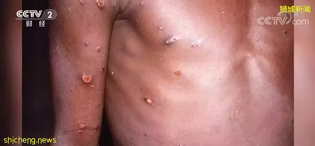 全球爆罕见传染病致死率10%,新加坡专家有疫苗无需担心