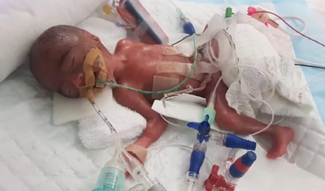 新國體重最輕早産兒　女寶寶出生只有345克