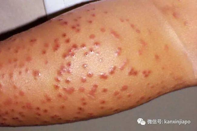 李显龙曾警告的神秘“X疾病”出现0号病人,死亡率可达90%