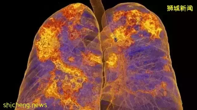 新冠研究:辉瑞防重症强过科兴但弱于莫德纳