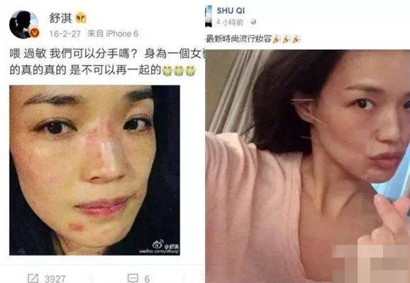 前英国王妃、女神舒淇都为针灸疯狂，在新加坡哪里找