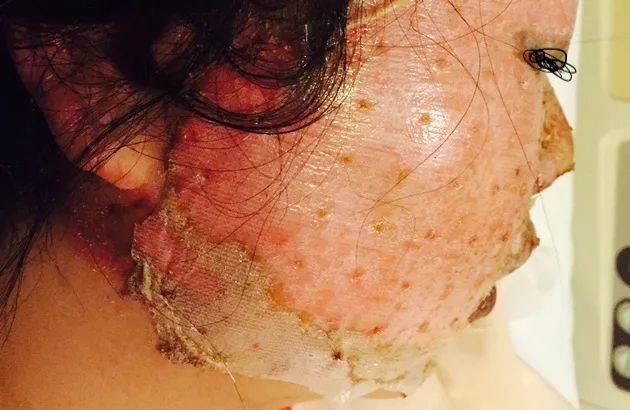 6年前,她在新加坡的中餐馆被毁容!最终获赔10万新币