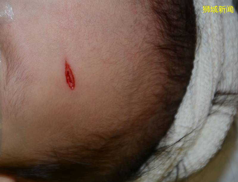 网友：一岁半的女儿在新加坡幼儿园受伤缝针，却没有人能说清楚