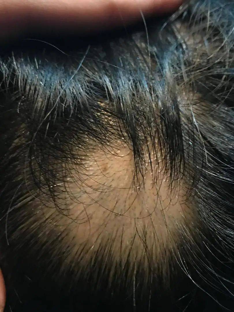 獅城這些“禿”如其來的煩惱,讓它幫你解決