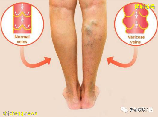 中國客工出院18天後病逝,新加坡醫生:久坐沒活動引發肺動脈栓塞!