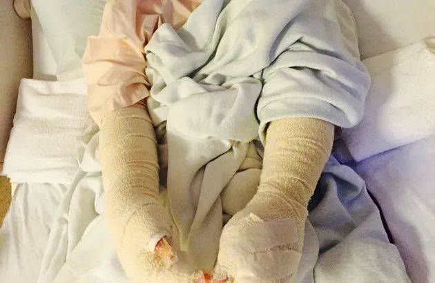 6年前,她在新加坡的中餐馆被毁容!最终获赔10万新币