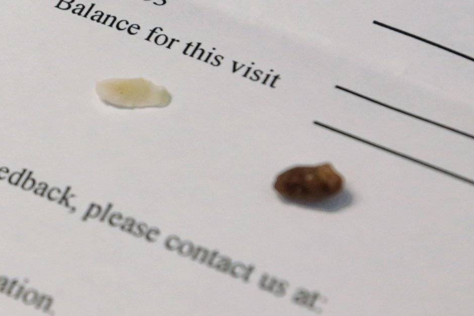 咬到石子  女客牙崩   香锅业者:愿赔一餐