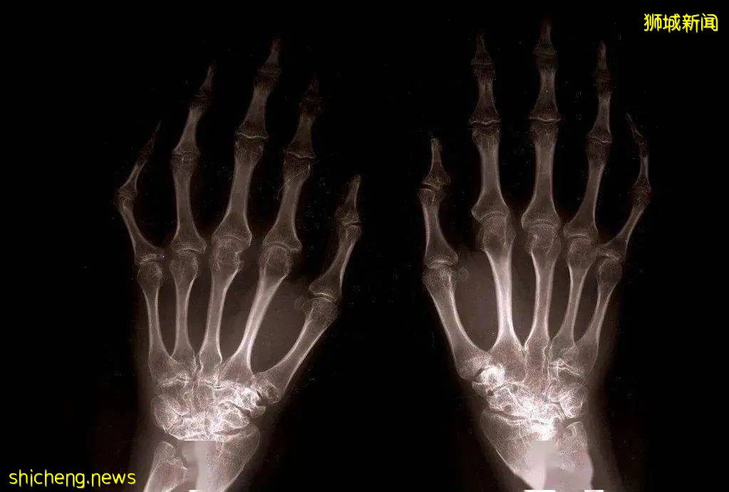 风湿病肆虐新加坡，我们该如何预防