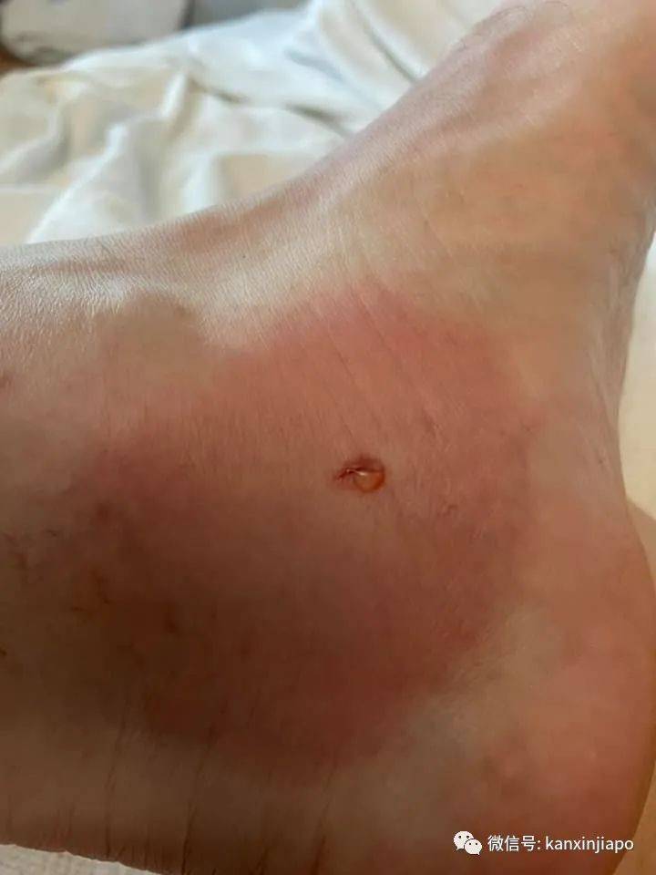 注意!剧毒魔鬼鱼频繁出没圣淘沙,一天蜇伤两人送院治疗