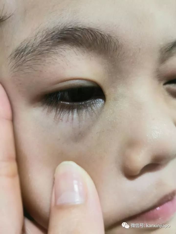 儿子身上多处瘀伤,母亲控诉新加坡幼儿园老师虐童!