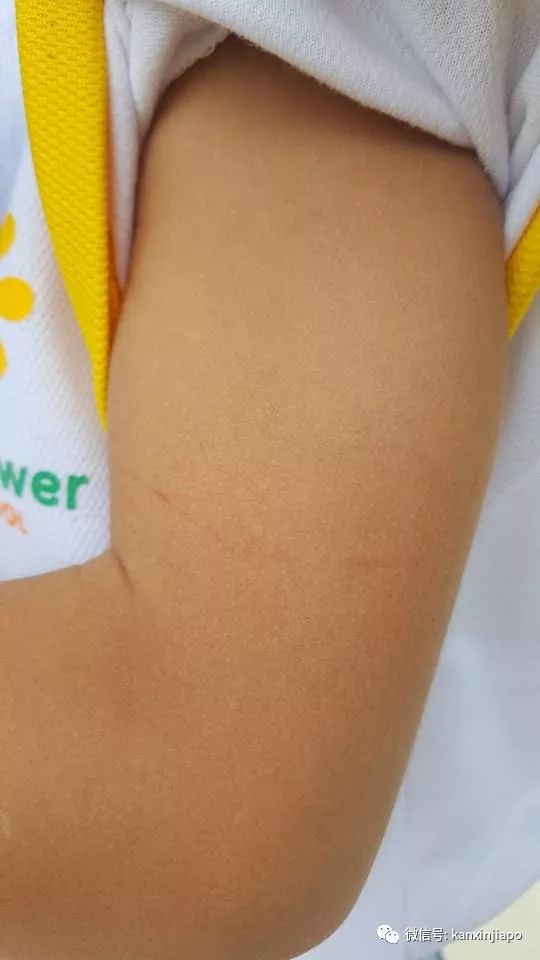 儿子身上多处瘀伤,母亲控诉新加坡幼儿园老师虐童!