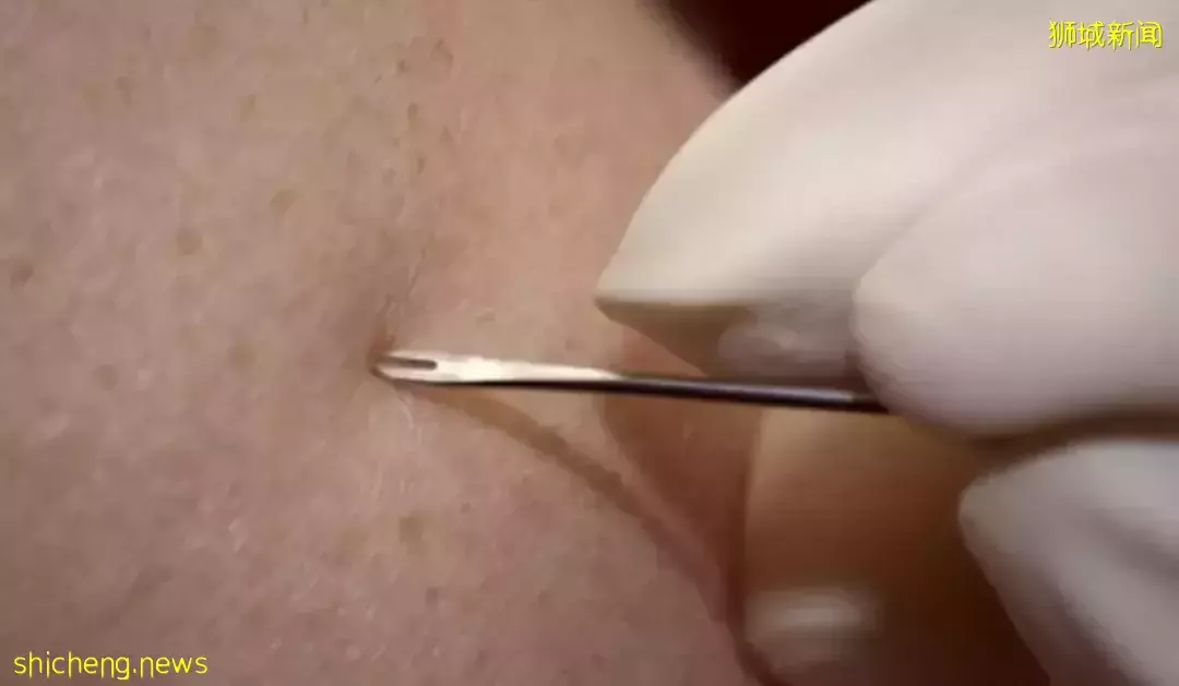 猴痘人传人,已对全球公共卫生构成中度风险