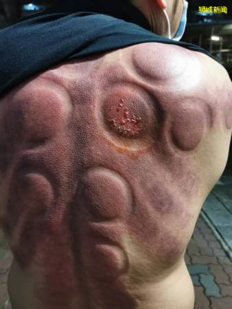 厨师拔罐解酸痛 背部灼伤起水泡 痛到只能趴着睡觉