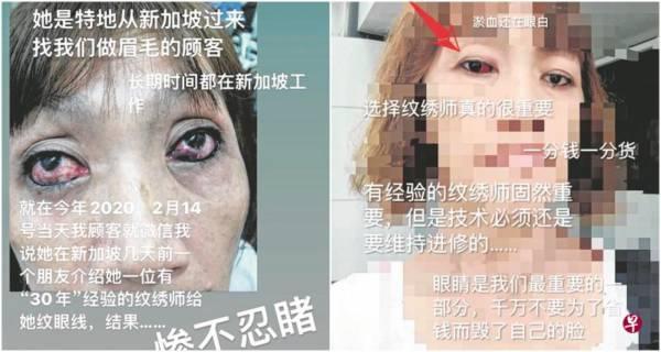 找文绣师文眼线 女子双眼红肿留淤血