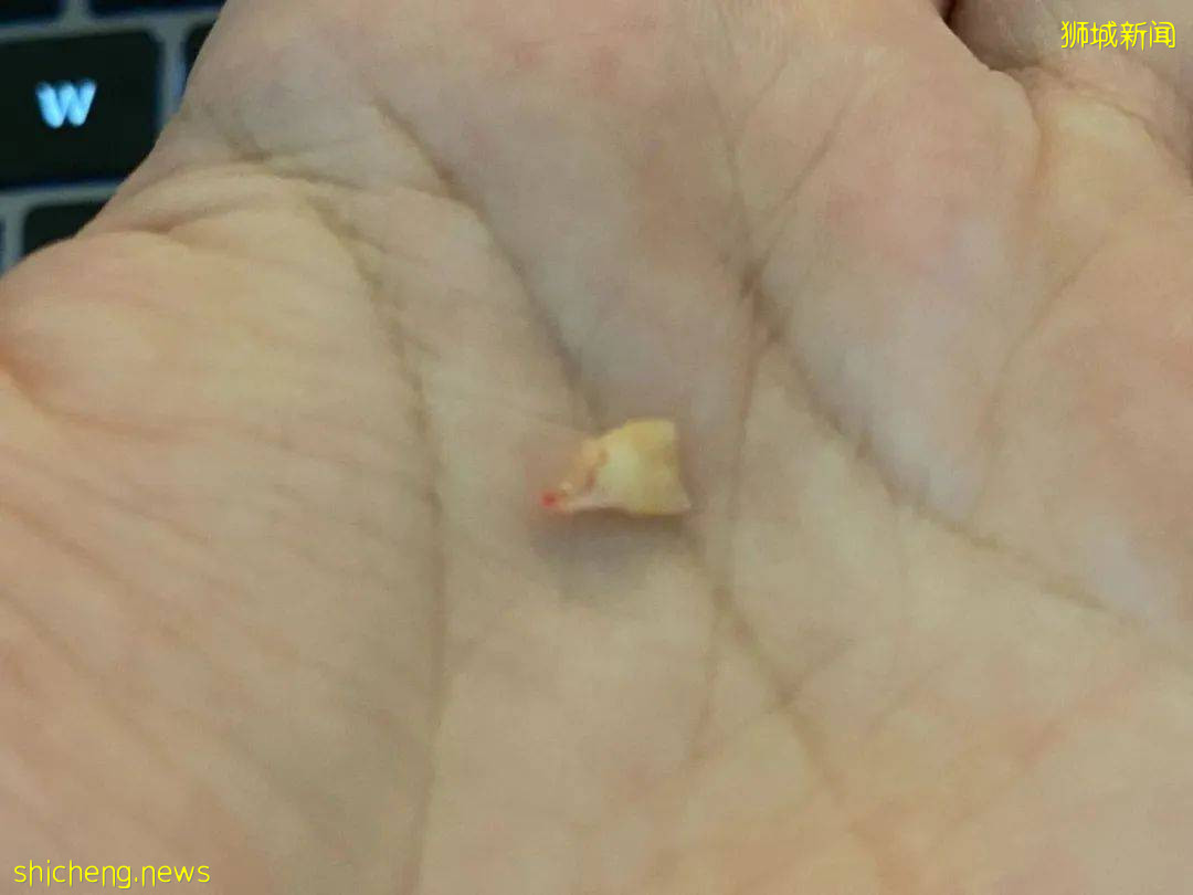 5歲女童拔牙後腦死亡!你還敢隨便在新加坡給孩子拔牙嗎