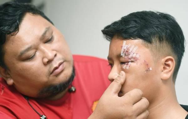 少年喂了野猫回家 竟遭家猫飞扑狠咬 眼珠险没了