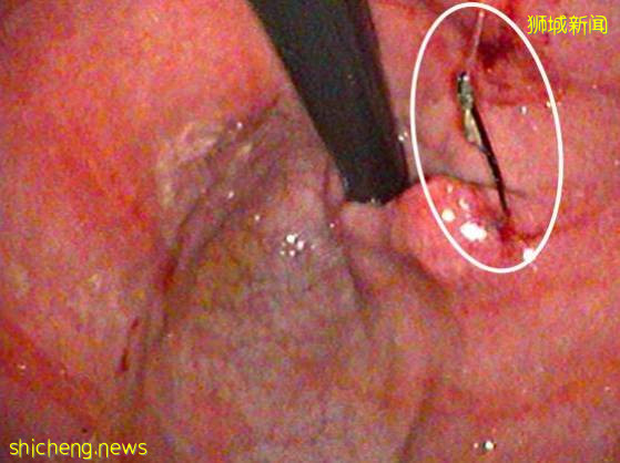 鱼钩伤人又伤猫,希望新加坡钓鱼人妥善处理废弃渔具