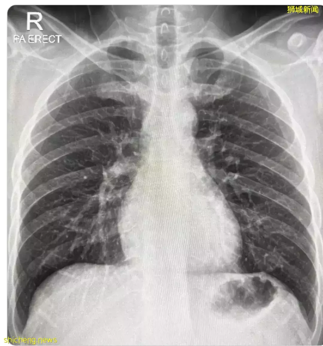 卫生部最新建议：这些人打第4针疫苗！奥密克戎后遗症全球首曝光