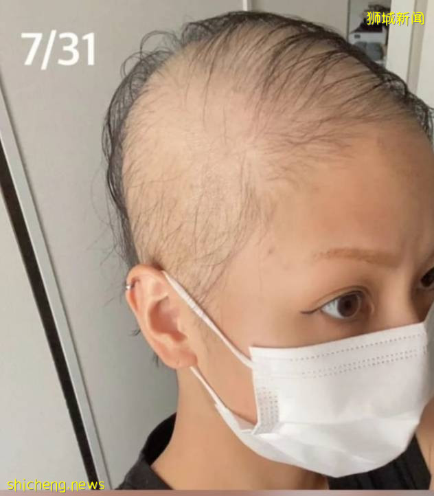 新加坡有人打完2針疫苗後,狂掉頭發!禿了