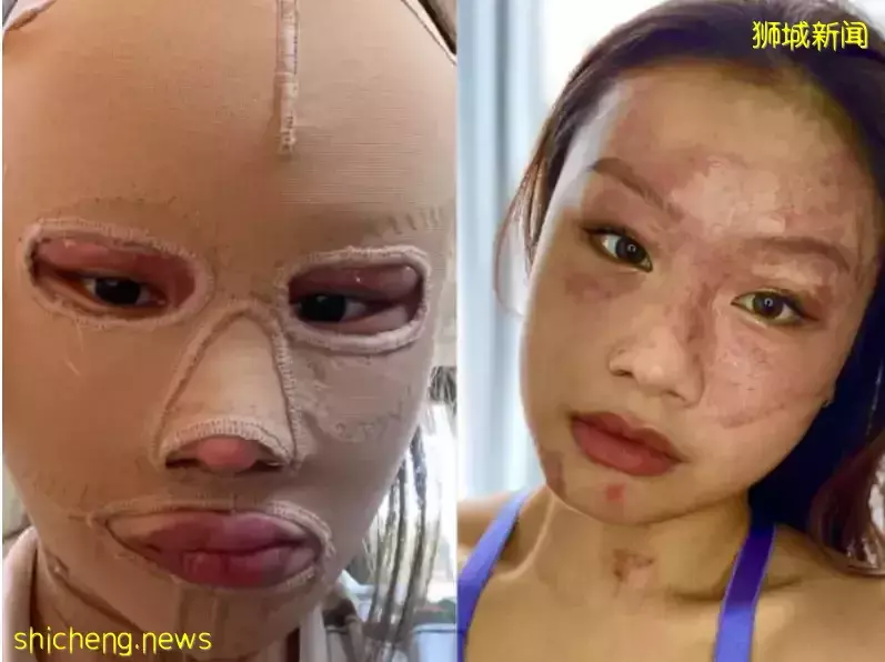 新加坡燒傷“幸存者”Chew，被美國真人秀明星卡戴珊稱爲"女王"