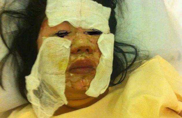 6年前,她在新加坡的中餐馆被毁容!最终获赔10万新币