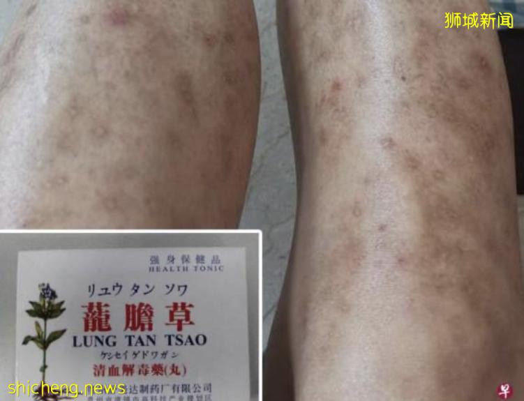 妇女误服“解毒药” 导致脸浮肿体重增