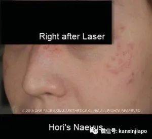 来到新加坡后，长了莫名其妙的斑，涂不掉也遮不掉