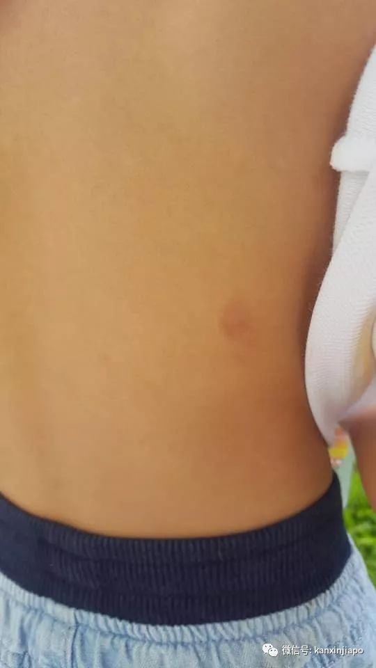 儿子身上多处瘀伤,母亲控诉新加坡幼儿园老师虐童!