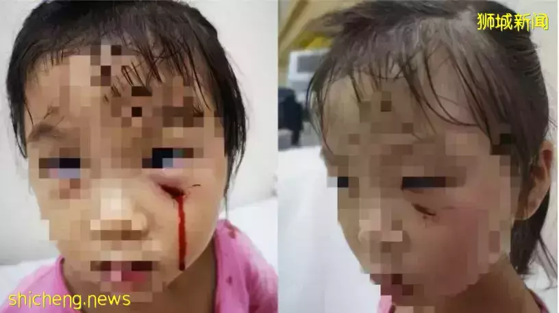 新加坡孔雀啄傷女童事件更多細節流出，傷口長三公分、主人後院全是禽類