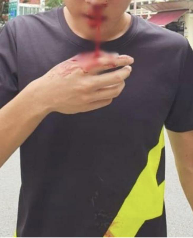 学生疑争风吃醋打人 少年鼻梁中拳血流不止