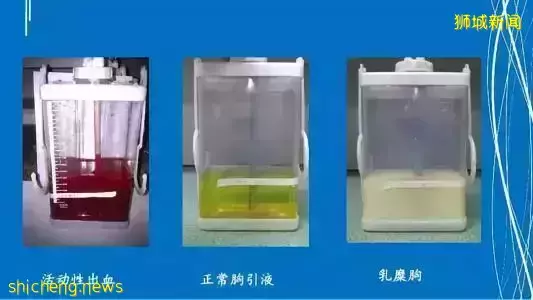 他,感染新冠后,被抽出一升黑色积液!新加坡医院开始增加床位