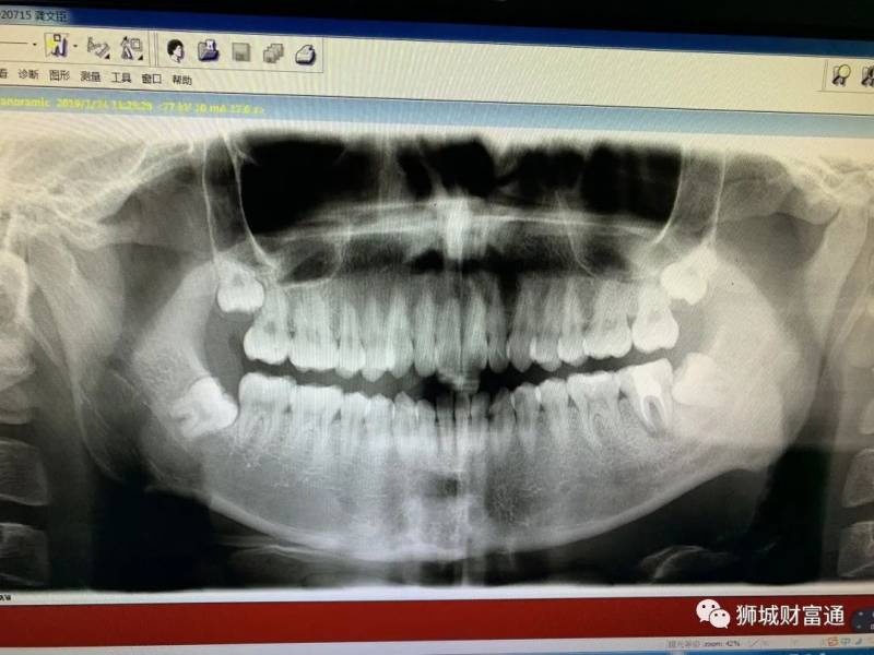 疫情回不了国,要拔智齿怎么办