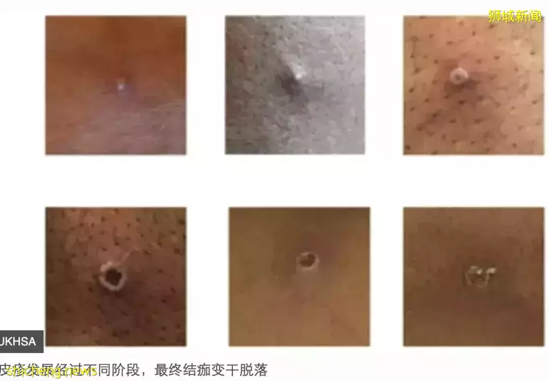 新加坡发现首起本土猴痘病例，源头成谜！患者实拍自述感受！这次会学中国吗
