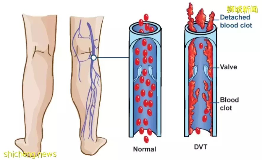 確診後6個月內患血栓風險高,輕症患者也不例外