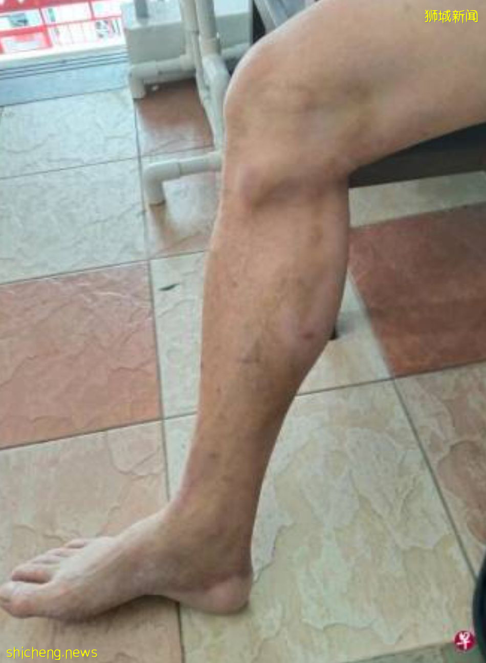 組屋6台電梯一起失靈 阿叔拖著傷腿 爬12層樓