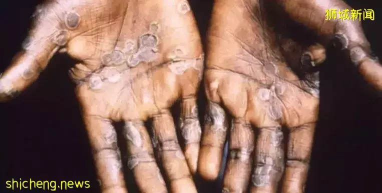 新加坡：本地尚未出现猴痘病例，但民众需加强防范