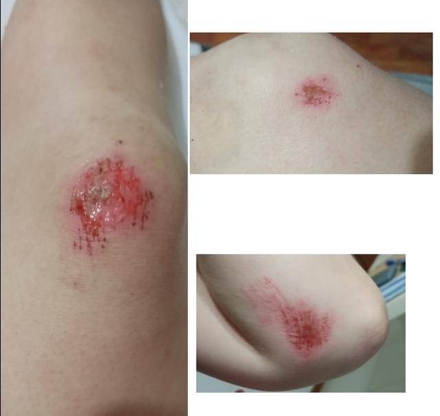 公园夜跑被绊倒,新加坡政府处理流程全记实