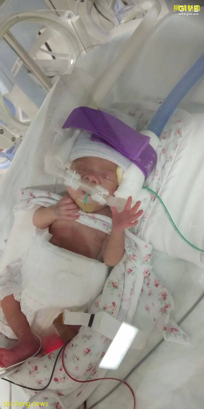 全世界最輕早産兒在新加坡出生,住院13個月後成功回家