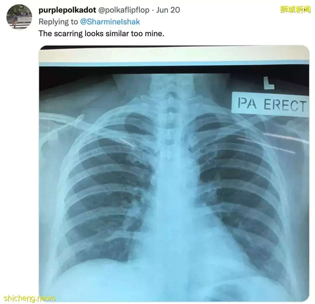 卫生部最新建议：这些人打第4针疫苗！奥密克戎后遗症全球首曝光