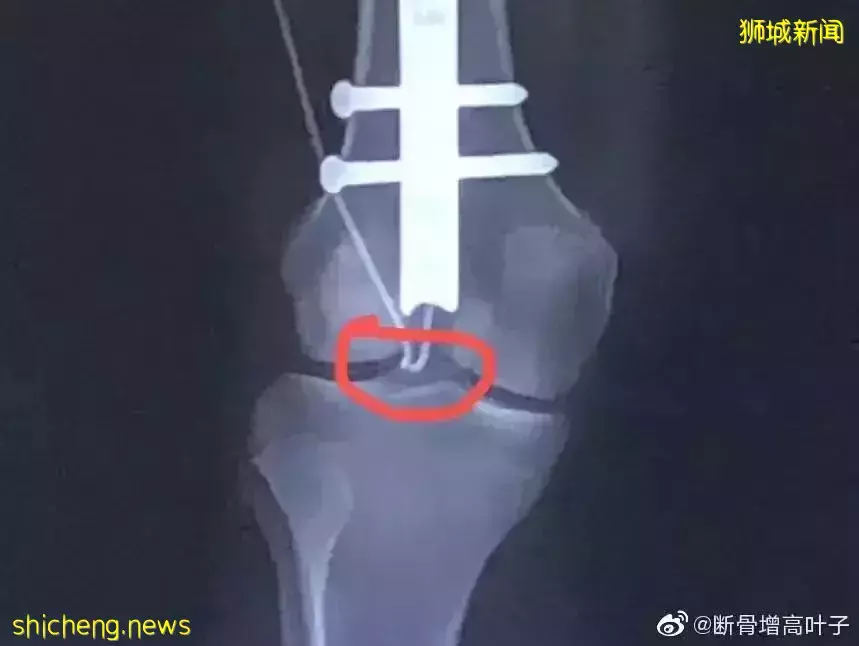 新加坡医生回应!中国女子控诉花50万做“断骨增高”手术失败