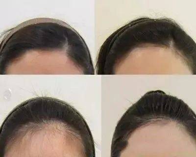 獅城這些“禿”如其來的煩惱,讓它幫你解決