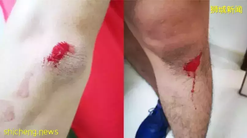 新加坡孔雀啄伤女童事件更多细节流出，伤口长三公分、主人后院全是禽类