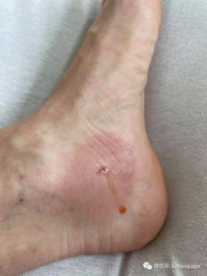 注意!剧毒魔鬼鱼频繁出没圣淘沙,一天蜇伤两人送院治疗