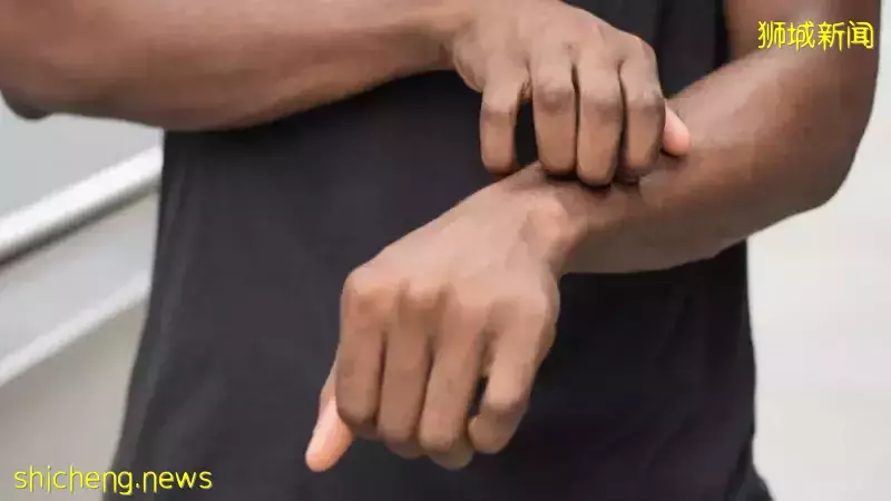 王乙康:新加坡迟早会有猴痘!这个国家取出40年前封存的天花疫苗