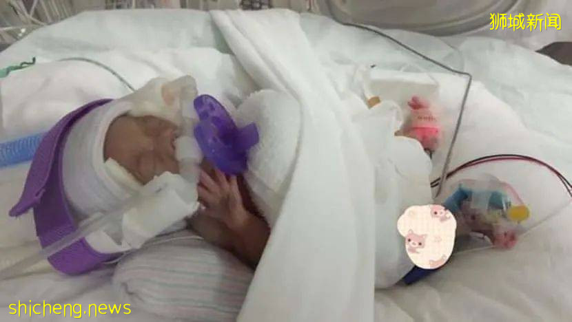 全世界最輕早産兒在新加坡出生,住院13個月後成功回家