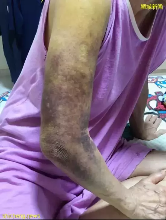 阿嬷遭电动脚车扯倒 右臂粉碎骨折 